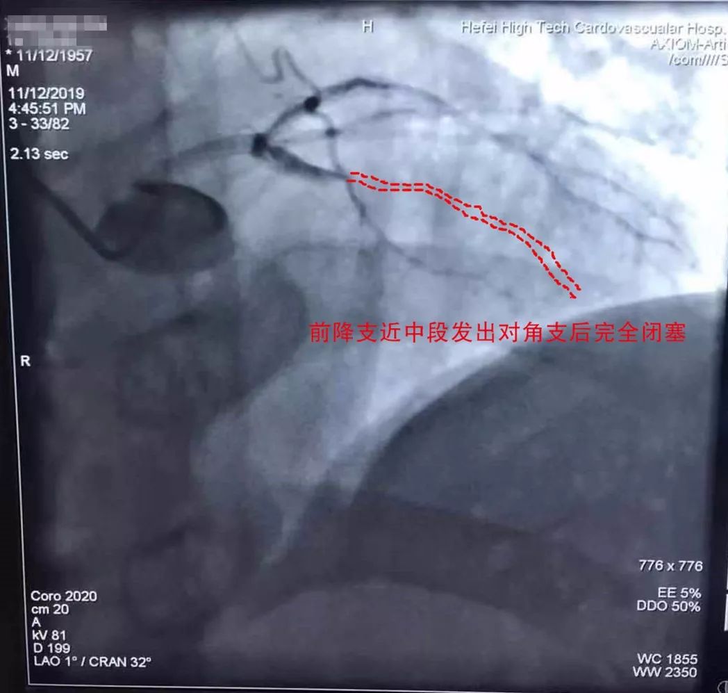 (图一 前降支近中段发出对角支后完全闭塞)看到刘大爷复查动脉造影