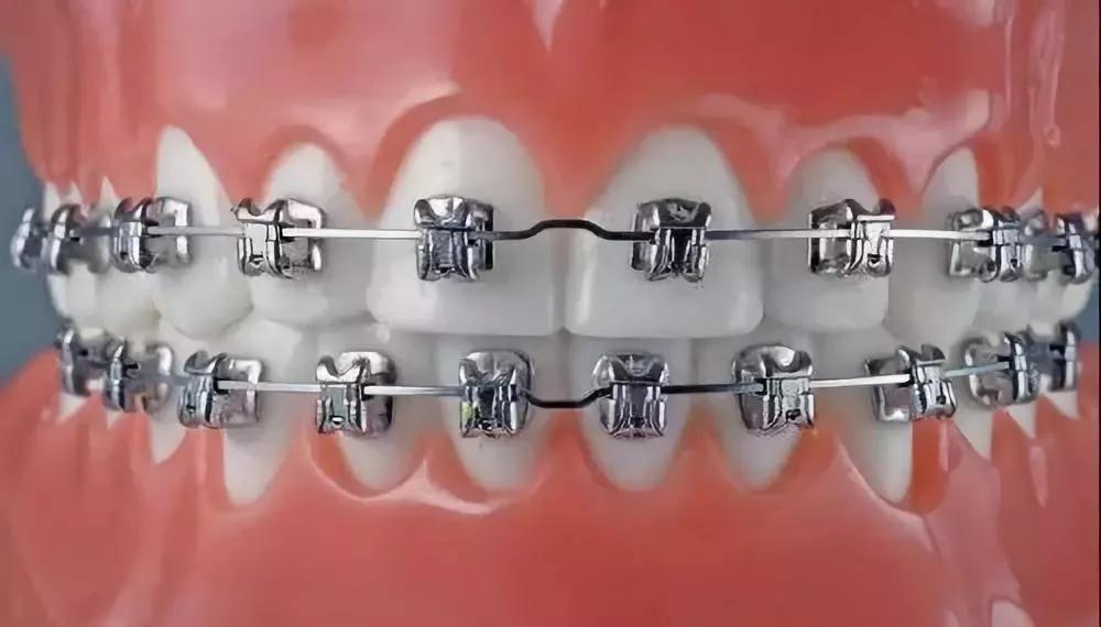 哪种牙齿矫正方式好?