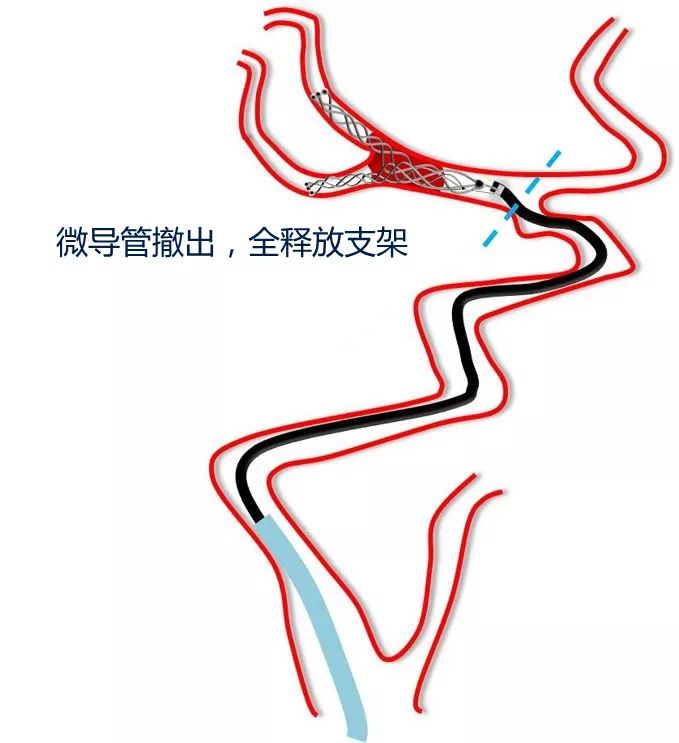 黄金波教授大脑中动脉分叉部solitaire双支架夹栓术再通一例