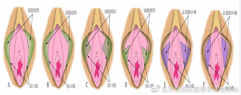 女性私密整形小阴唇整形手术之热点问答