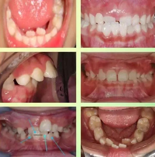 如何正确刷牙去牙黄 5484e05398184dda91b63c5b51b17c94.jpeg