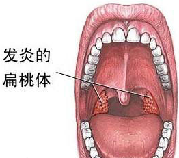 孩子感冒喉咙痛怎么办