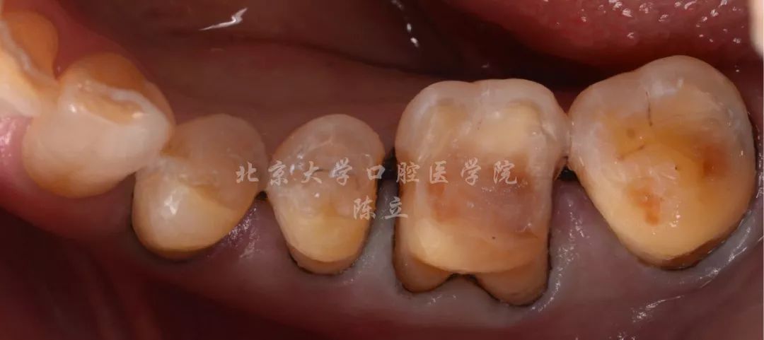 74舌侧设计为半冠型,颊侧设计为全冠型.