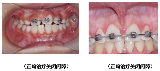 上唇系带断裂怎么办