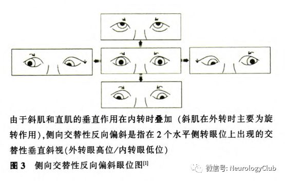 眼球偏斜反应常伴有主观视觉垂直倾斜.