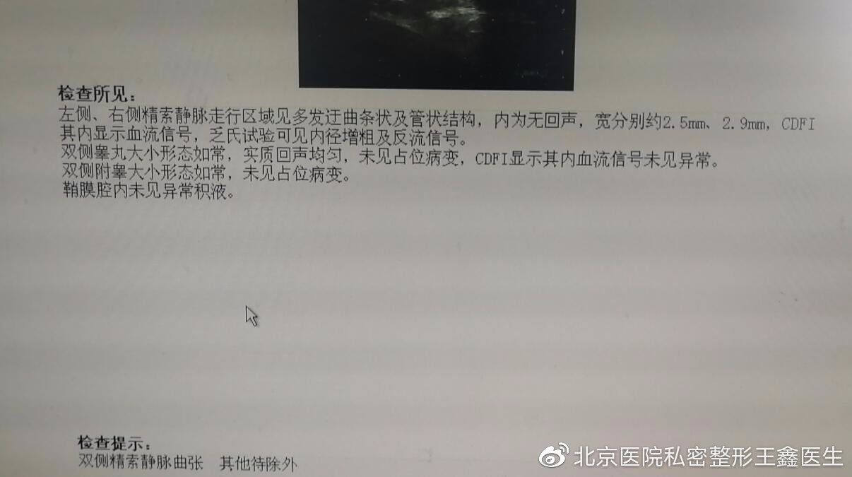 一例显微镜下精索静脉曲张手术