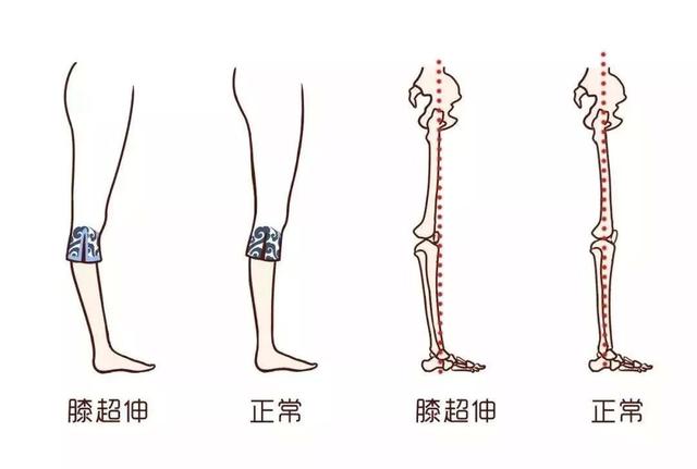 原创改善膝超伸保护膝关节