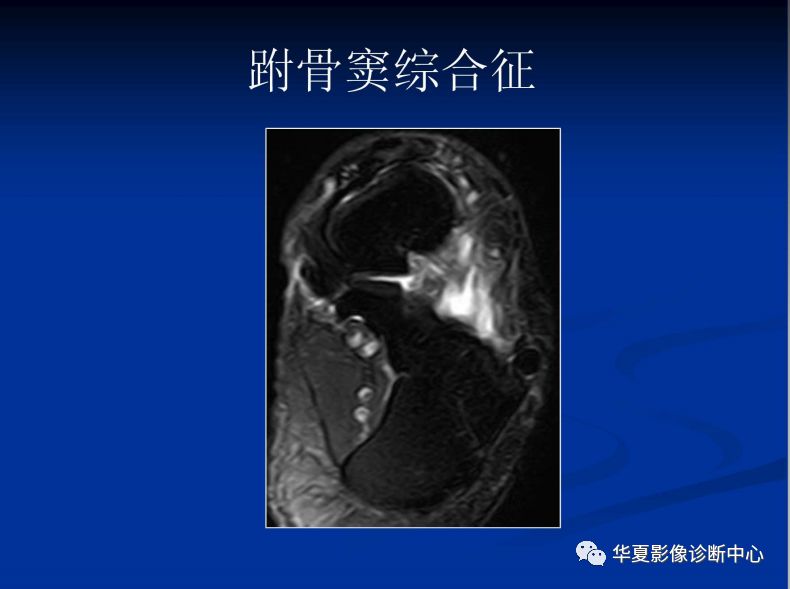 跗骨窦综合征