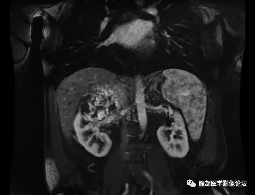 renal cell carcinomawith renal veinand ivc invasion