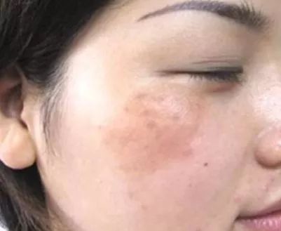 艾灸助女人青春不老，祛妇科病更要靠艾灸！ .艾灸养生