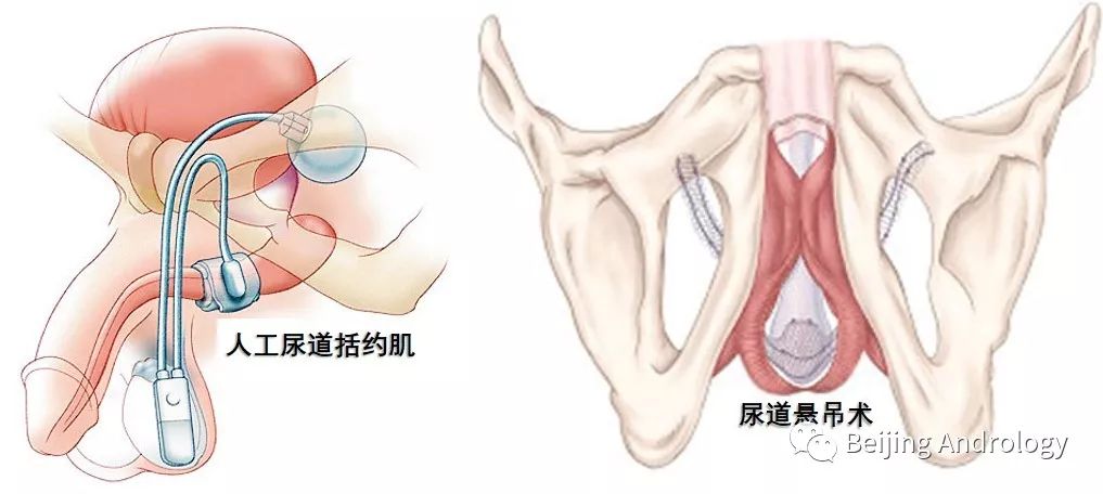 手术后尿失禁怎么办