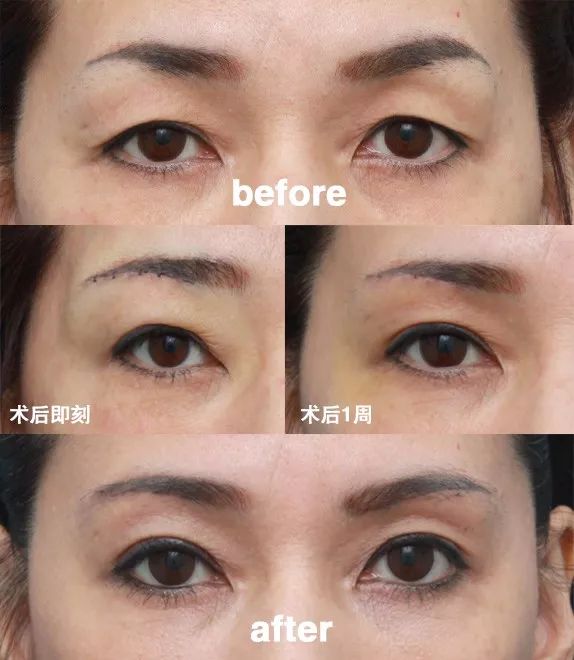 眼皮松弛是做双眼皮好还是做切眉好