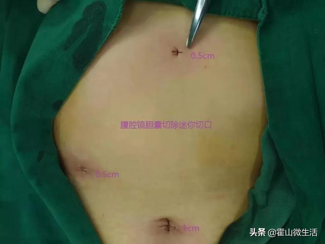 霍山县医院首例迷你切口腹腔镜胆囊切除术成功