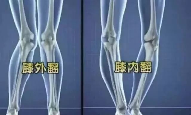 例如膝盖外翻,就会形成x型腿;而如果膝盖内翻,就会形成o型腿.