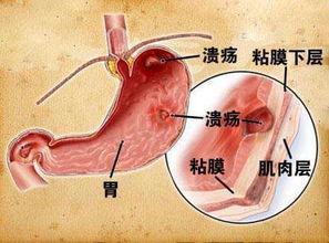 20岁的我因为一个坏习惯胃烂了一个洞很多人犯了同样的错误