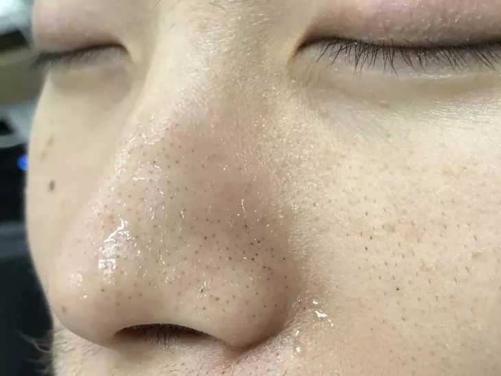 又爽又恶心的去黑头方法来了:5分钟将你10年的黑头白头连根拔起!