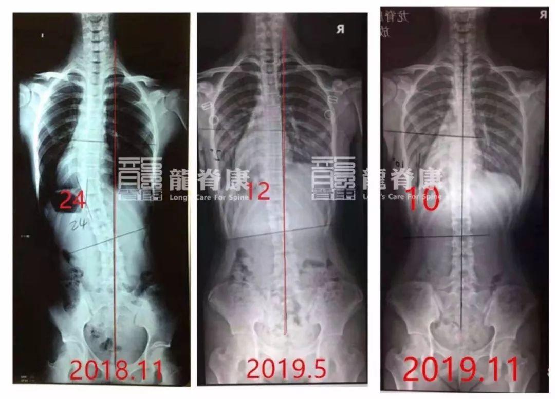 孩子戴支具前后x光片对比