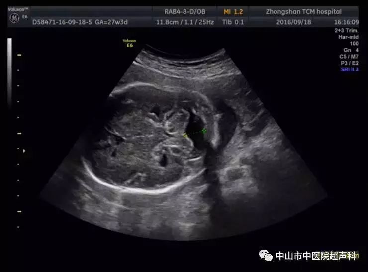 超全图解:产前超声能发现的14种胎儿微小畸形,你都知道吗?