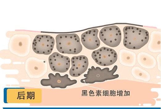 黑色素通过正常代谢途径分泌至皮肤表层黑色素细胞分泌黑色素色斑的