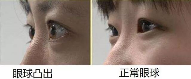 眼球凸出与否,除了和眼轴长度相关,还和每人的眼眶大小有关.