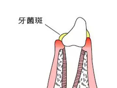 有了牙菌斑是不是一定要洗牙