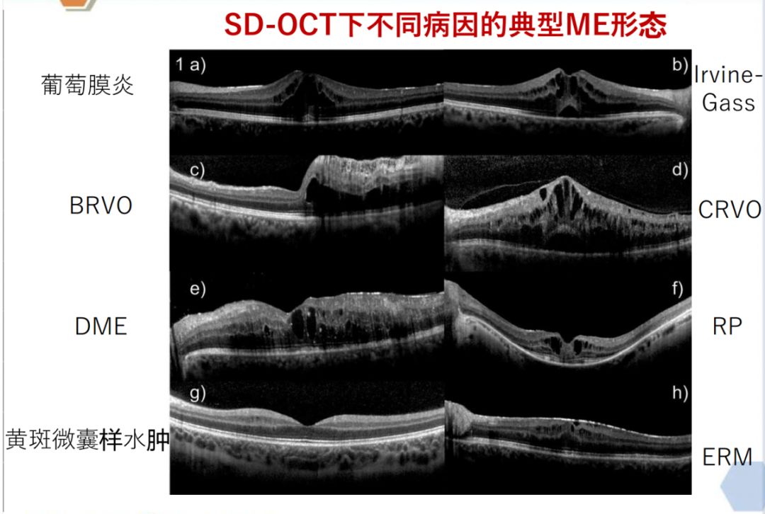 年龄相关性黄斑变性(amd),葡萄膜炎等,而oct在黄斑水肿(me)管理中具有