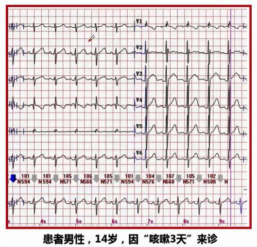 房间隔缺损怎么办