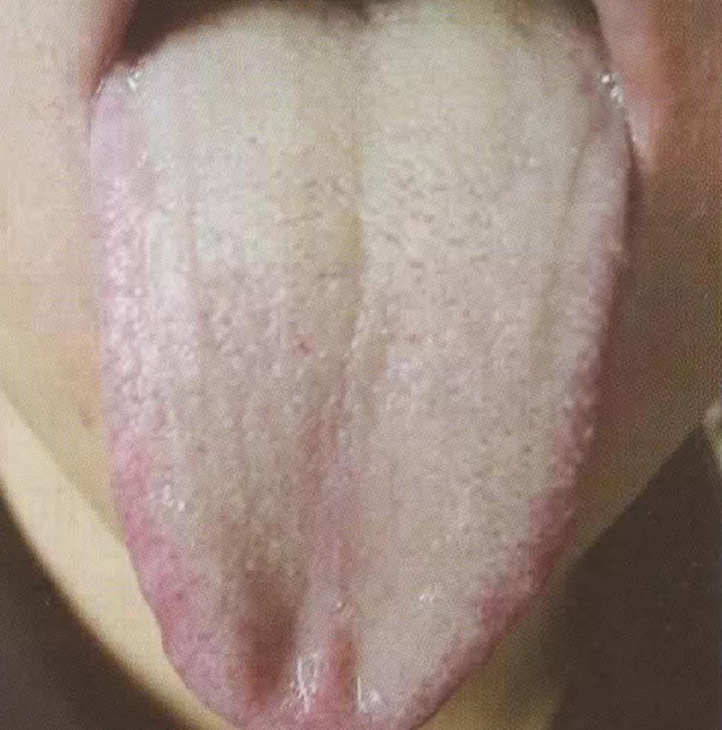 舌苔 - 快懂百科