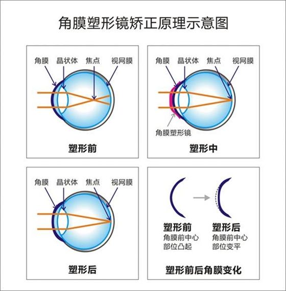 塑形镜的原理_△角膜塑形镜视力矫正原理(2)