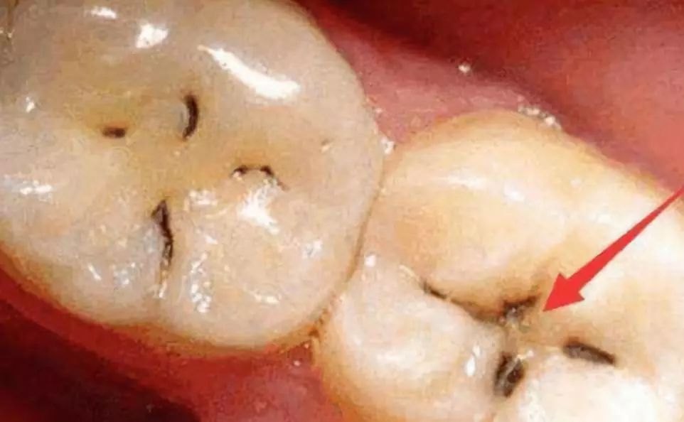 牙缝长的黑线,其实就是窝沟龋,也就是常说的蛀牙.