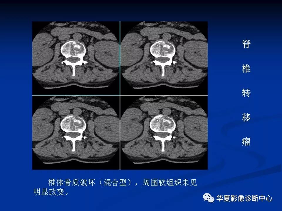 影像重温丨腰椎结核的ct诊断与鉴别诊断