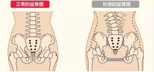 产后骨盆修复你可能需要了解下