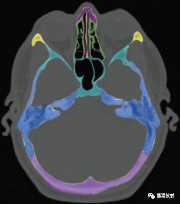 颅底解剖及相关病变丨ct平扫的价值