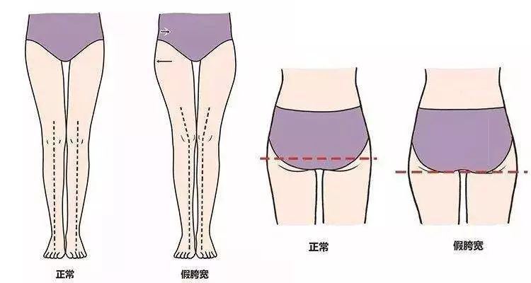 久坐会让臀部堆积脂肪,大腿根部也会堆积脂肪,下垂的臀部最宽的地方
