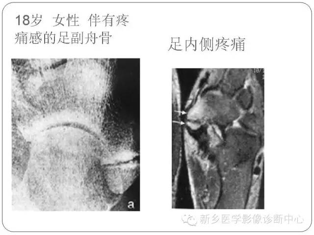 如何鉴别诊断足舟骨骨折,副舟骨?