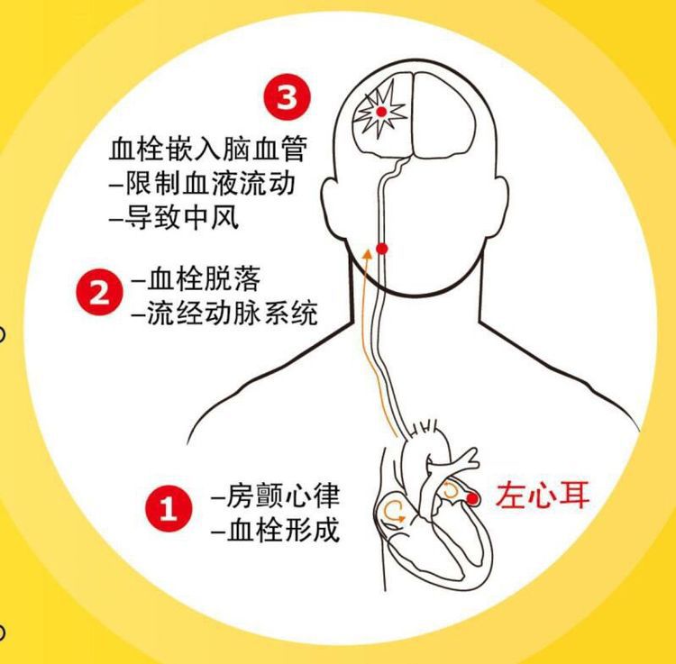 左心耳封堵术:预防血栓的"黑科技!