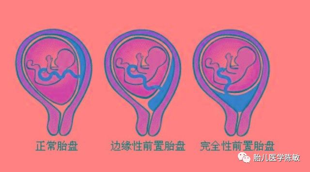 怀孕多久可以看出来前置胎盘 754a20ba48ba475f8a4d8e7fef2b5cc2.jpeg