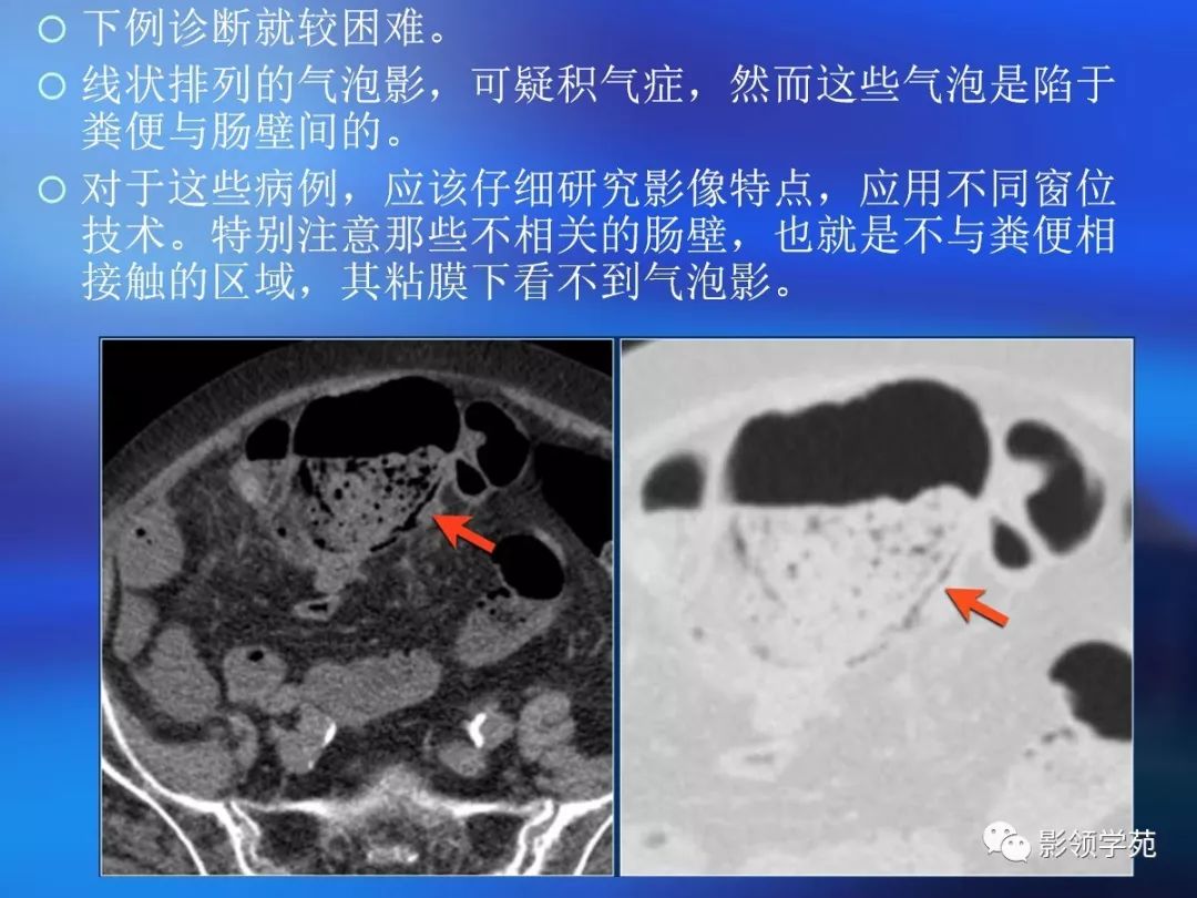 脂肪有时见于乳糜泻ct 评价肠壁增厚存在的问题肠道是蠕动的空腔器官