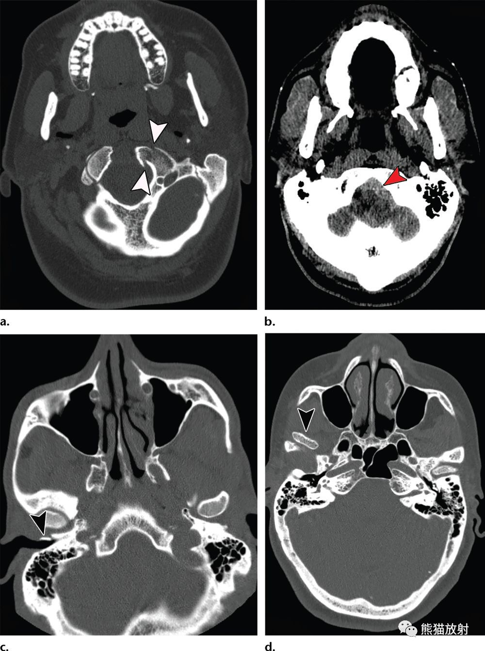 颅底解剖及相关病变丨ct平扫的价值