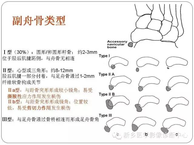 如何鉴别诊断足舟骨骨折,副舟骨?