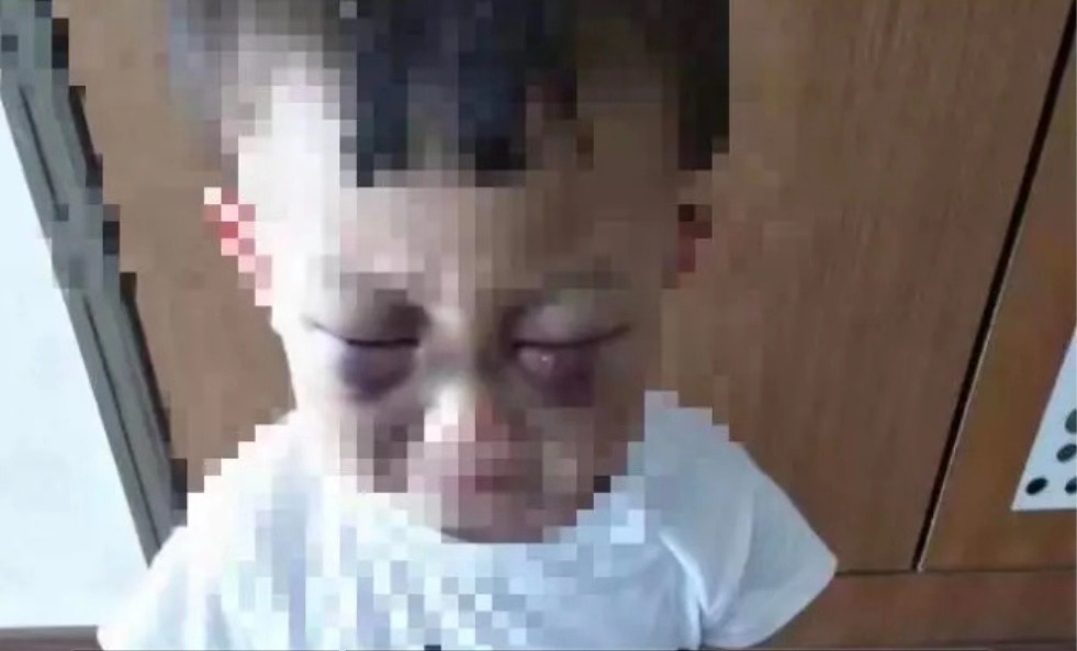 山东3岁男童遭虐待浑身淤青继母供认多次拳打嘴咬