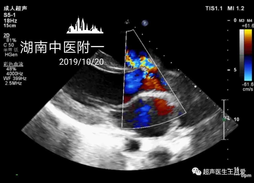 浅谈室间隔缺损与主动脉窦瘤破裂