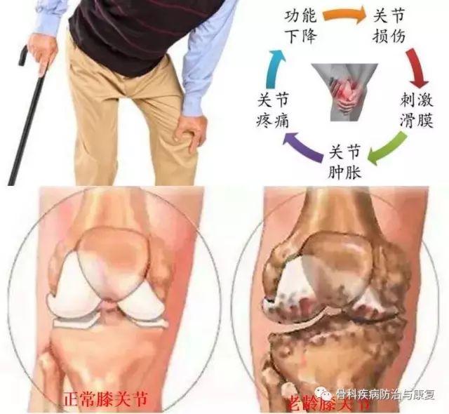 膝盖滑膜炎怎么形成的 b1b7ca0e50d544749b2f38b66c136867.jpeg