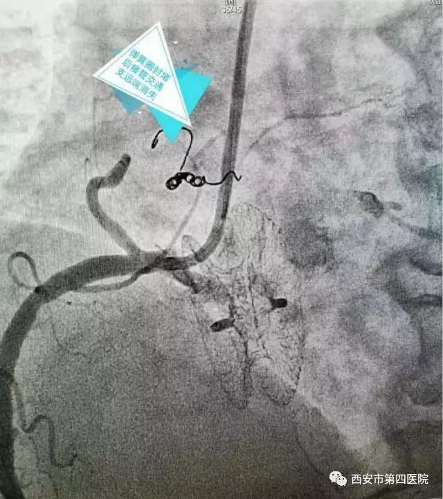 患者福音市第四医院心血管介入团队成功实施首例冠状动脉肺动脉瘘弹簧