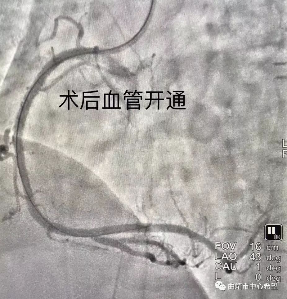 心血管病科再次成功完成一例冠心病cto病变介入手术