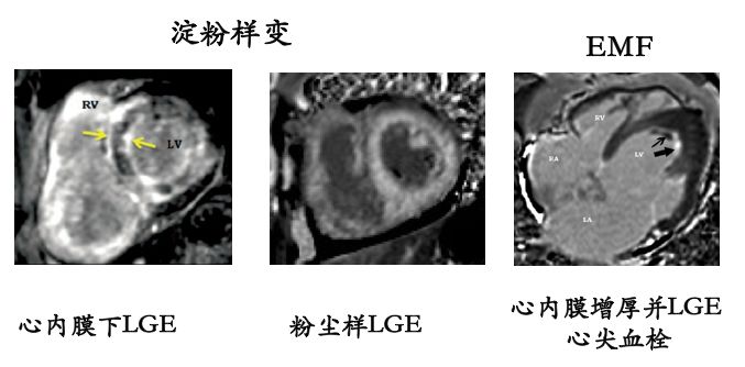 【2019cihfc】姚亚丽教授:限制性心肌病的诊断要点