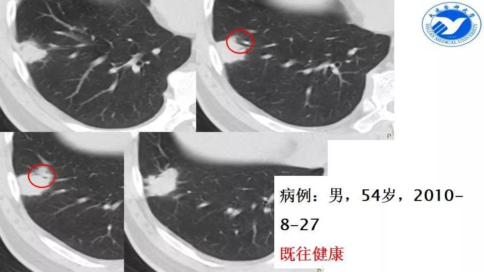 动脉早期呈现多发小结节聚合 征象 提示2: 周围型肺肉芽肿——聚合