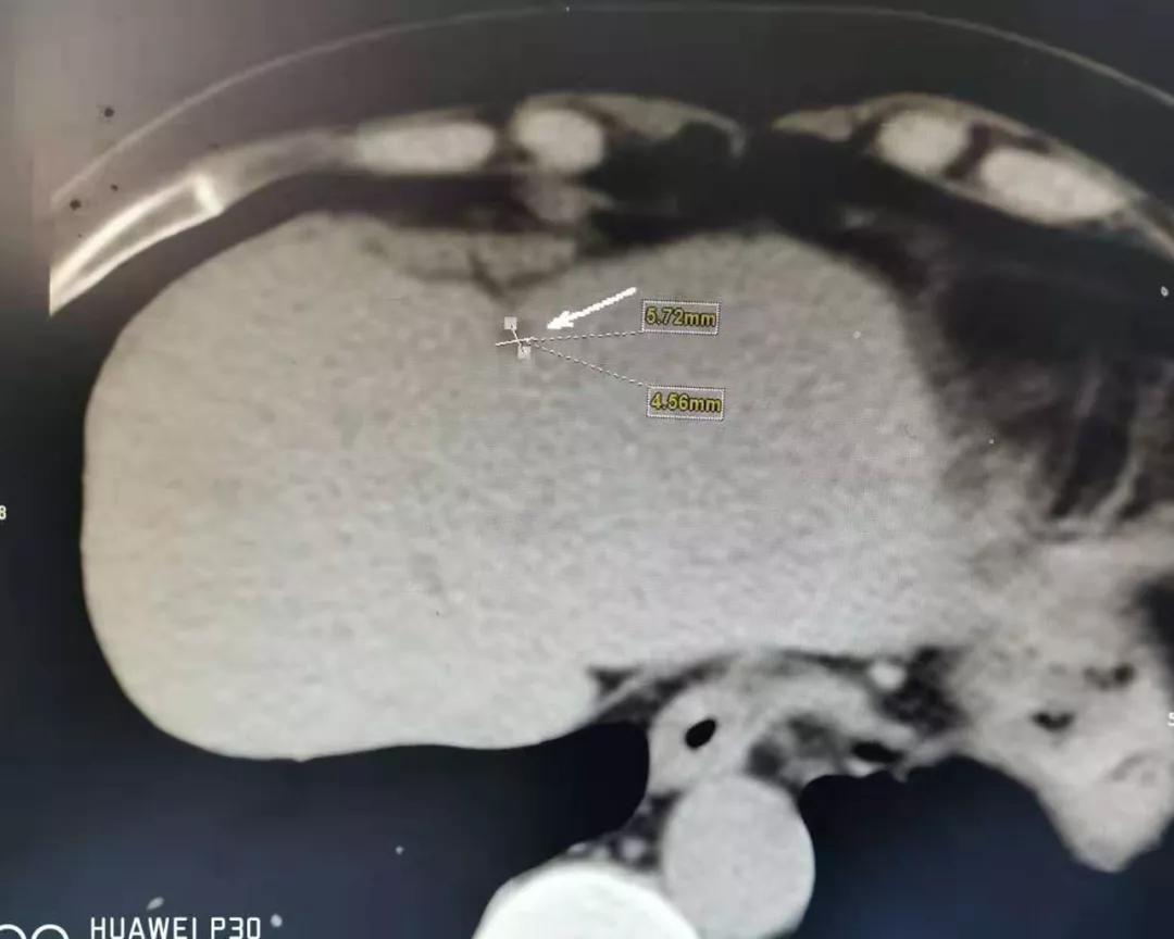 该病友胰腺内肿块基本消失,肝脏最大占位也从29mm缩小至6mm,肿瘤标志