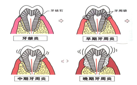 成语什么毁削骨_成语故事简笔画(3)