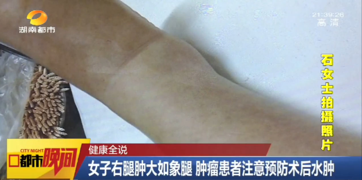 女子右脚肿大如象腿 肿瘤患者注意预防术后水肿